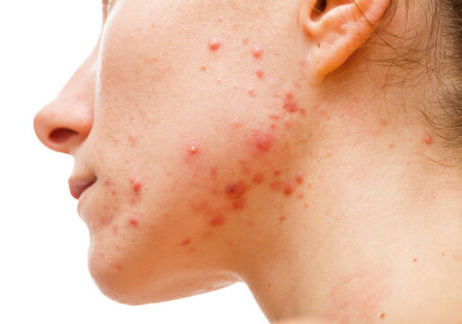 understanding acne