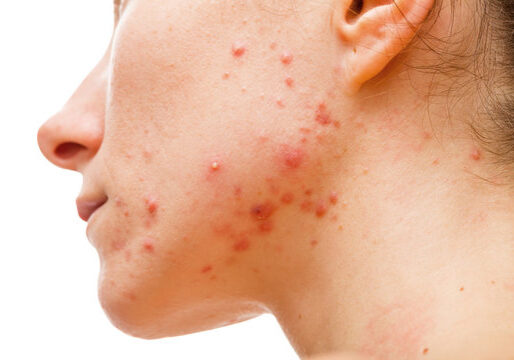 360_F_61720335_JwepU3uoZxfAyaBAyNyDBdknV0FnmWvv understanding acne
