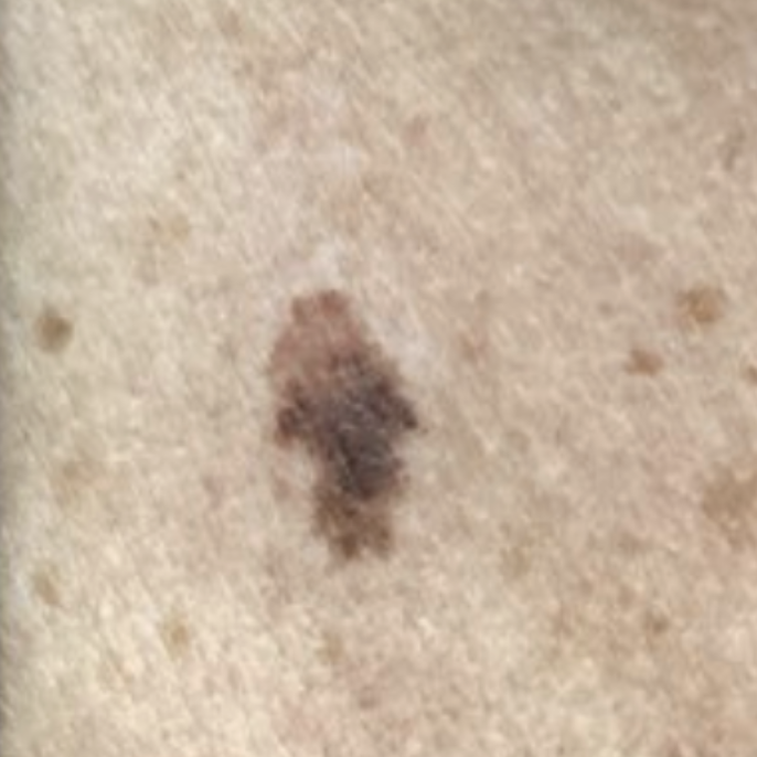what does melanoma look like?