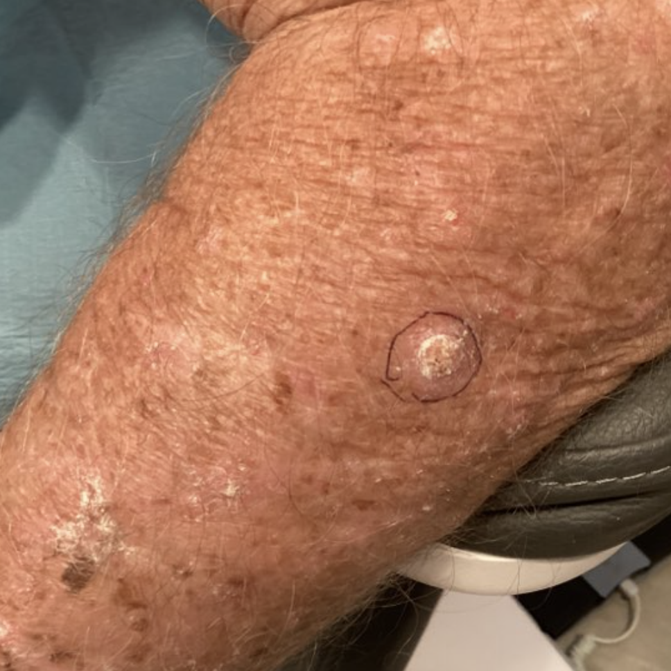 what does squamous cell carcinoma look like