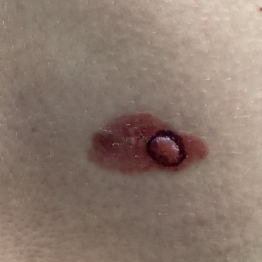 what does basal cell carcinoma look like